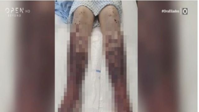 Σοκάρουν οι εικόνες 34χρονης που εμβολιάστηκε με AstraZeneca