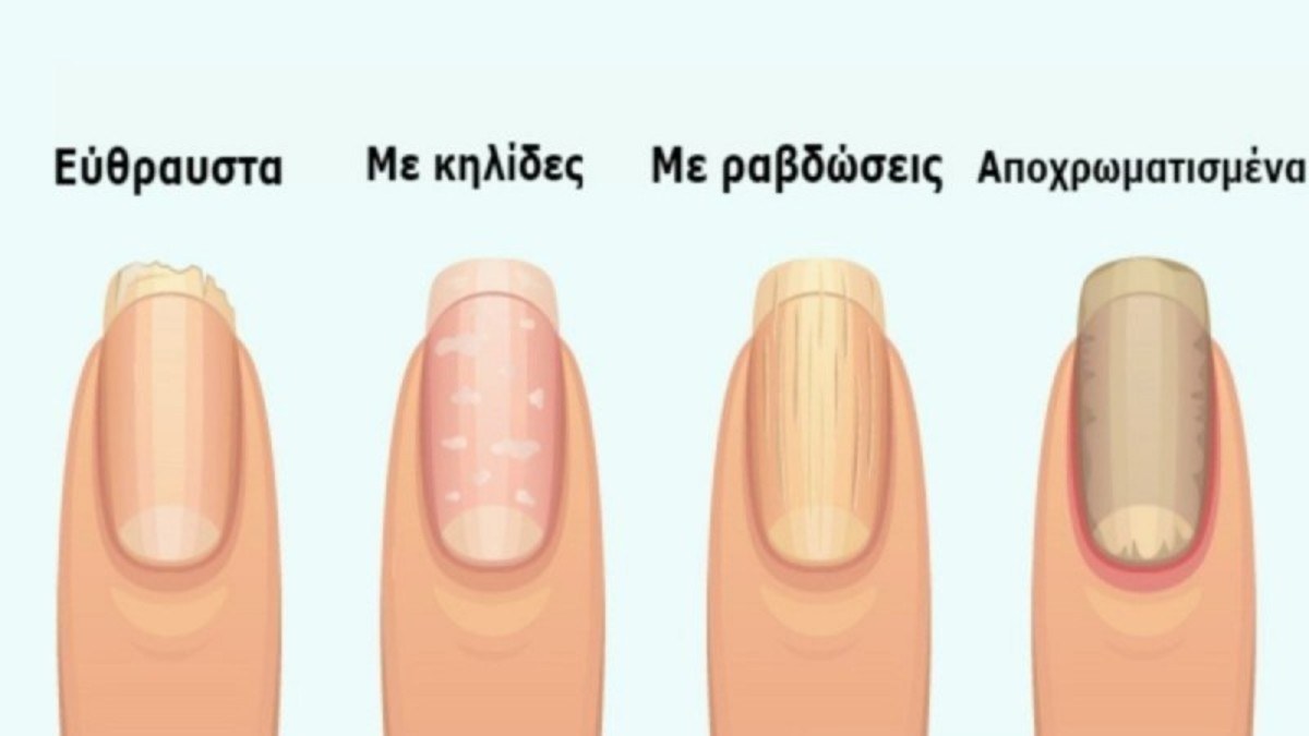 7 + 1 σημάδια στα νύχια που προειδοποιούν για σοβαρά προβλήματα υγείας