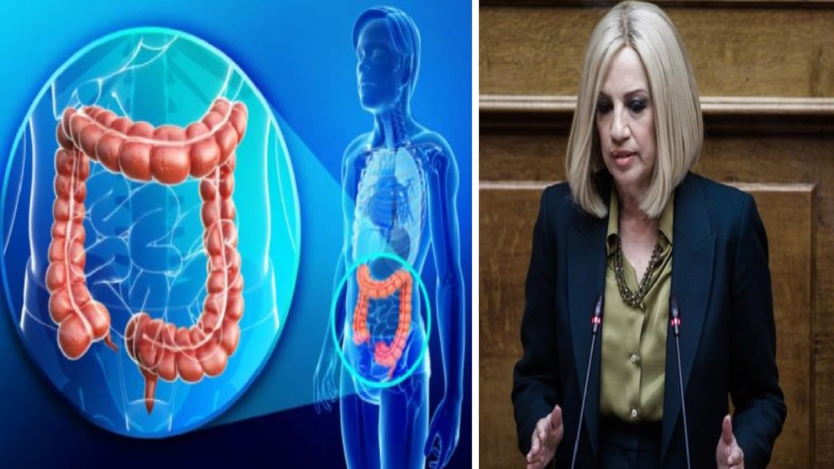 Eιλεός: Τι είναι και τι τον προκαλεί – Η πάθηση του εντέρου από την οποία πάσχει η Φώφη Γεννηματά (Video)