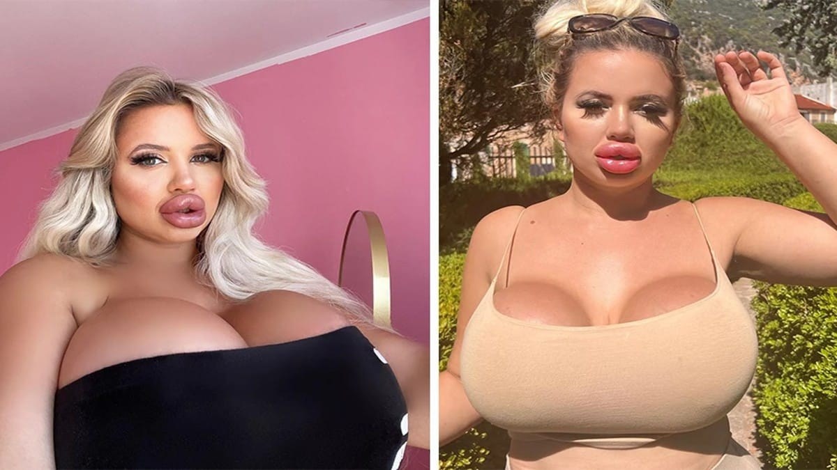 Έδωσε 57.000 ευρώ σε πλαστικές για να γίνει «Barbie» και τώρα δεν της μιλάει…