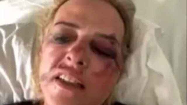 Καλαμάτα: Σοκάρει η γυναίκα που δέχθηκε επίθεση από αδέσποτα σκυλιά – «Προσπάθησα να τα αποφύγω…»