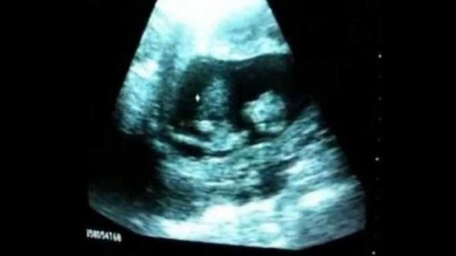 Η εγκυμονούσα μαμά μαζί με τον σύζυγό της πήγαν στον γυναικολόγο για υπερηχογράφημα – Αυτό που είδαν δεν το περίμενε κανείς!