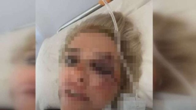 Καλαμάτα: Συγκλονίζει 34χρονη που την κατασπάραξαν σκυλιά – «Φοβάμαι να κυκλοφορήσω στον δρόμο! Παραλίγο να χάσω τη ζωή μου» (Video)