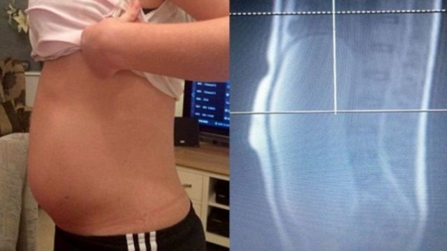 Νόμιζαν ότι αυτή η 17χρονη έφηβη ήταν έγκυος… Όταν όμως οι γιατροί είδαν την αξονική της «πάγωσαν»