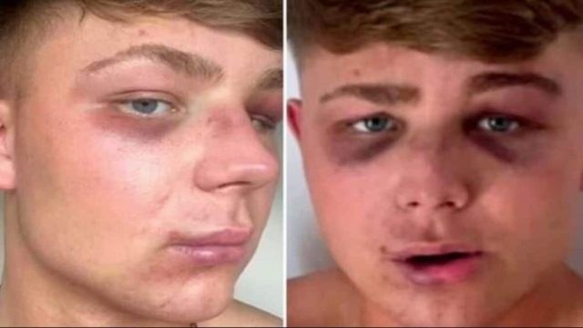 «Για μια selfie, με έστειλαν στο νοσοκομείο» – Συγκλονίζει ο Βρετανός που ξυλοκοπήθηκε από μπράβους στον Λαγανά