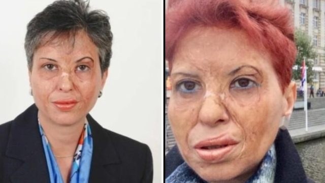 Καλλιόπη Αθανασιάδη: Η επιζήσασα ενός φρικτού ατυχήματος που έγινε η κορυφαία χειρουργός της Ελλάδας