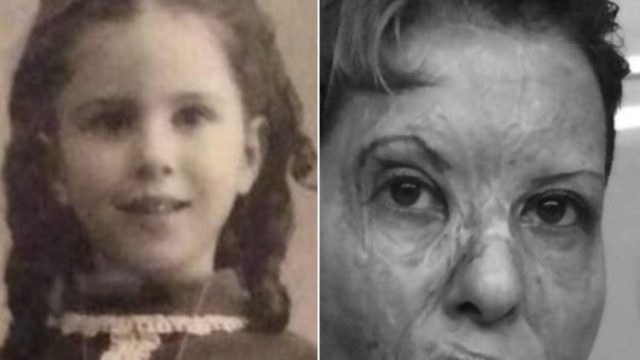 Καλλιόπη Αθανασιάδη: Συγκλονίζει η κορυφαία θωρακοχειρουργός 54 χρόνια μετά το φρικτό ατύχημα – «Ένα σημάδι αντίφασης στον κόσμο…»