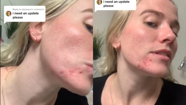 Επείγουσα προειδοποίηση: Το viral Tik Tok περιποίησης της επιδερμίδας «μπορεί να σας σημαδέψει» (Video)