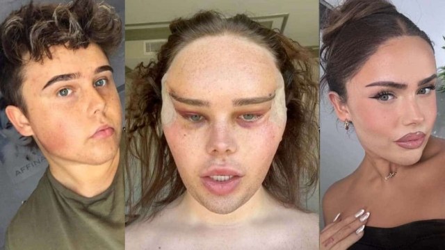 Trans Influencer αποκαλύπτει τα τρελά αποτελέσματα της πλαστικής επέμβασης ματιών “Foxy”