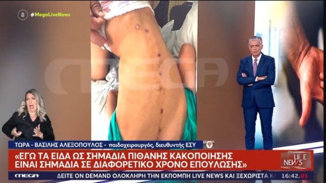 Κακοποίηση ή ατύχημα; Διαφορετικές εκδοχές για τα σημάδια στο σώμα του 10χρονου ΑμεΑ στην Πάτρα