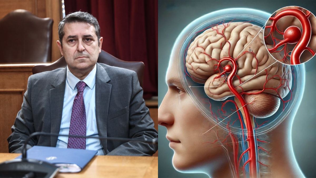 Τι είναι το εγκεφαλικό ανεύρυσμα που έπαθε ο Γιώργος Μυλωνάκης: Τα συμπτώματα και οι κίνδυνοι
