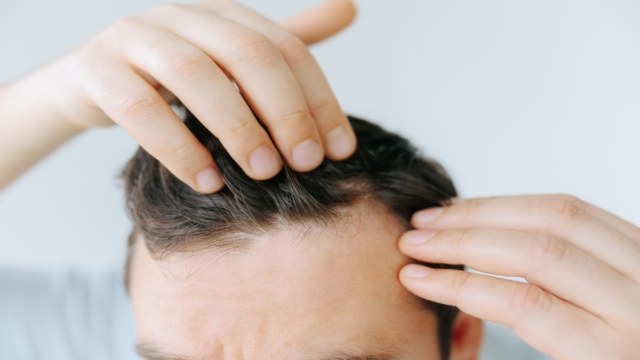 Έρευνα σοκ για την τριχόπτωση: Τι συμβαίνει στους θύλακες που σώζονται την τελευταία στιγμή;